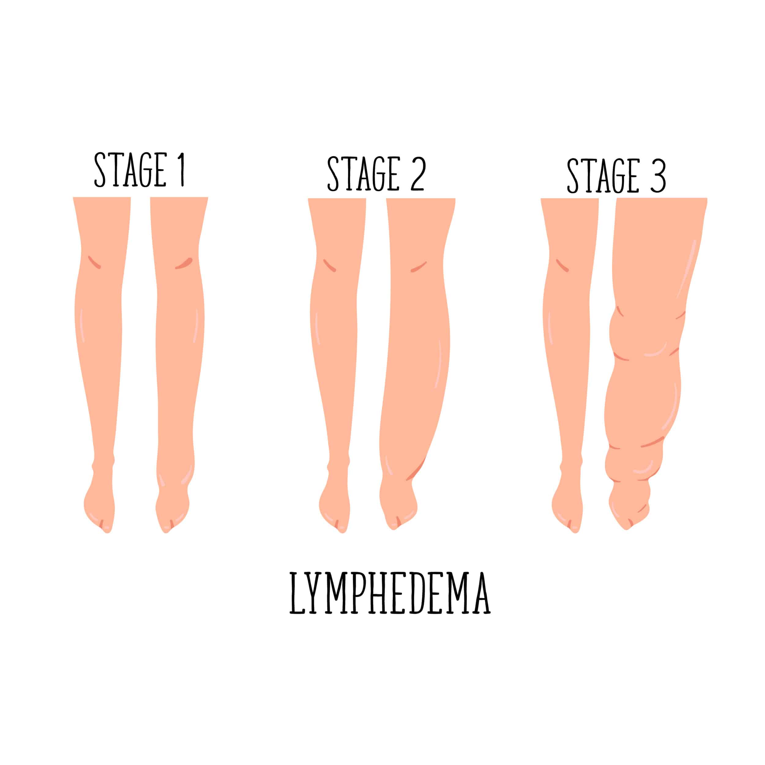 Drawing of a progressively more swollen leg, depicting the stages of lymphedema