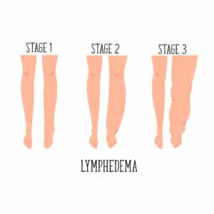 A graphic showing healthy legs, swollen legs, and severely swollen legs to depict the progression of lymphedema